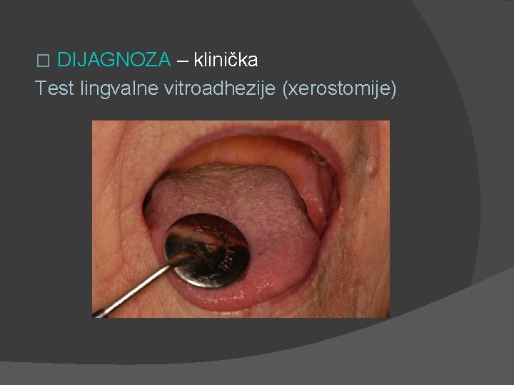 DIJAGNOZA – klinička Test lingvalne vitroadhezije (xerostomije) � 