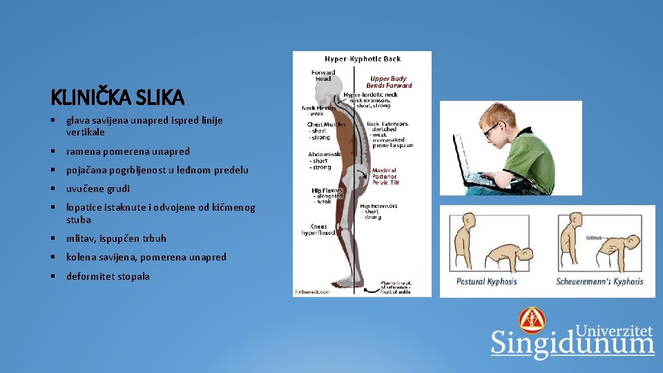 KLINIČKA SLIKA § glava savijena unapred ispred linije vertikale § ramena pomerena unapred §