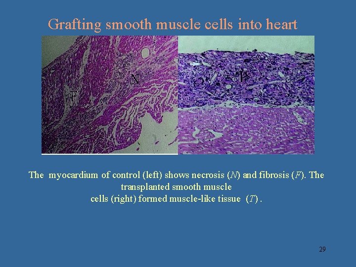 Grafting smooth muscle cells into heart The myocardium of control (left) shows necrosis (N)