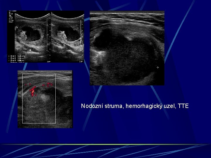 Nodozní struma, hemorhagický uzel, TTE 