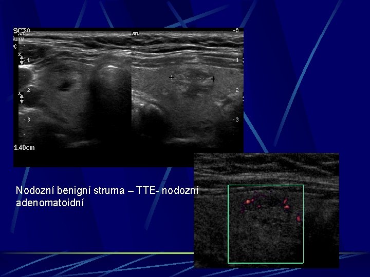 Nodozní benigní struma – TTE- nodozní adenomatoidní 