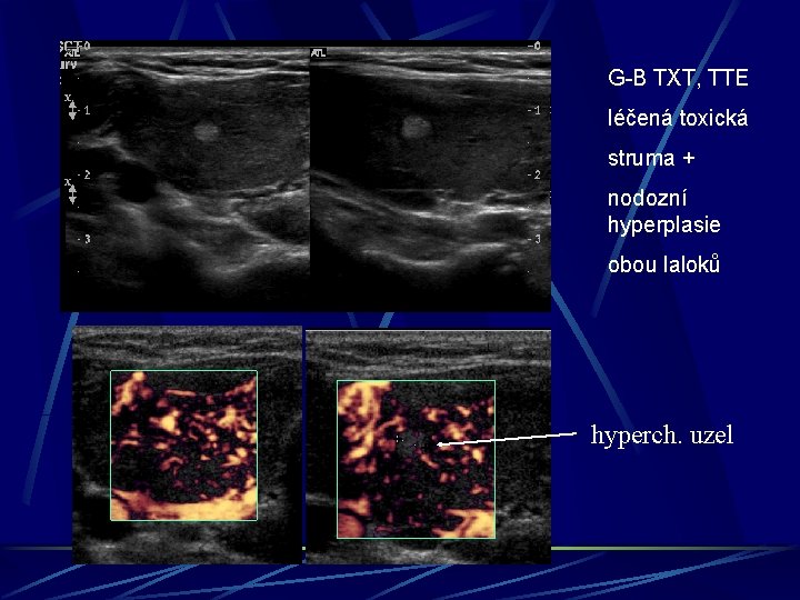 G-B TXT, TTE léčená toxická struma + nodozní hyperplasie obou laloků hyperch. uzel 