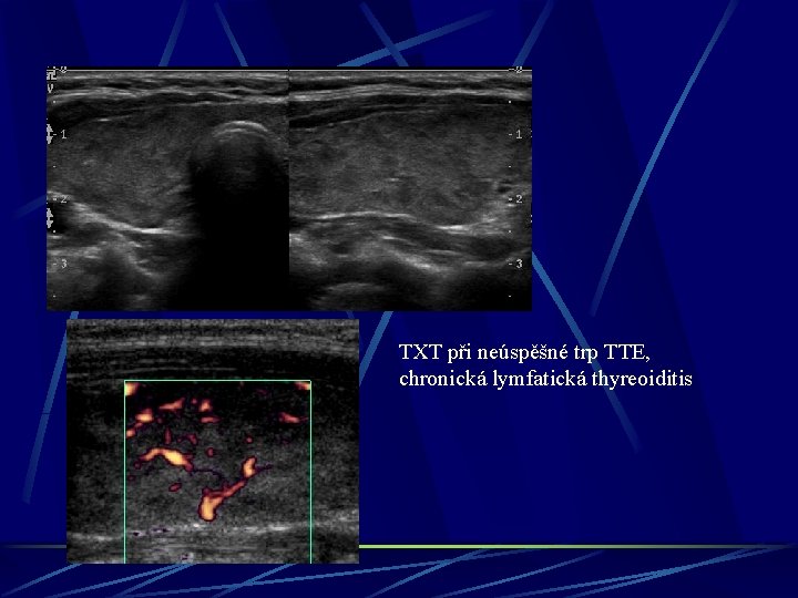 TXT při neúspěšné trp TTE, chronická lymfatická thyreoiditis 