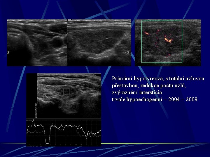 Primární hypotyreoza, s totální uzlovou přestavbou, redukce počtu uzlů, zvýraznění intersticia trvale hypoechogenní –