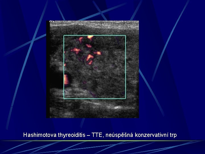 Hashimotova thyreoiditis – TTE, neúspěšná konzervativní trp 