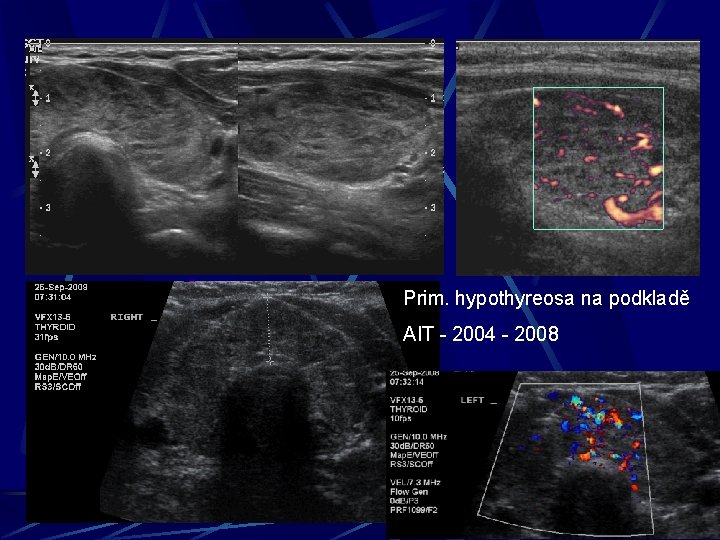 Prim. hypothyreosa na podkladě AIT - 2004 - 2008 