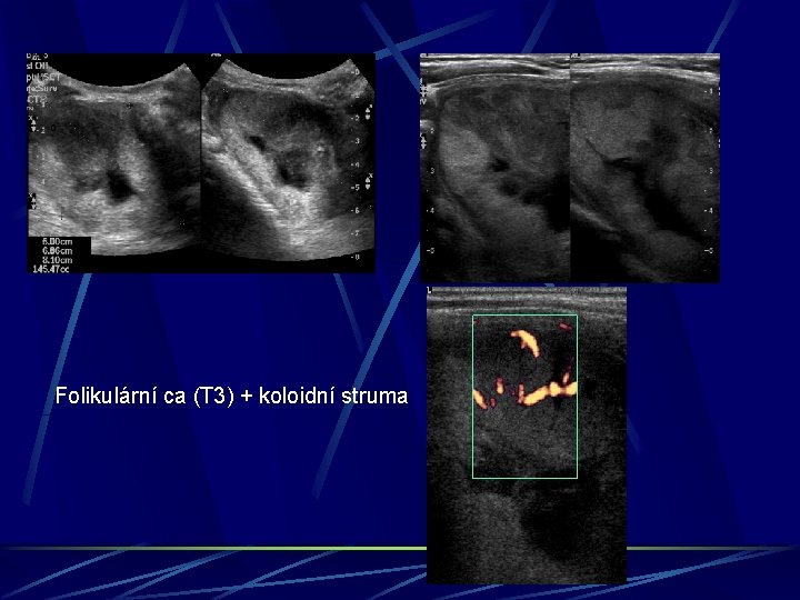 Folikulární ca (T 3) + koloidní struma 