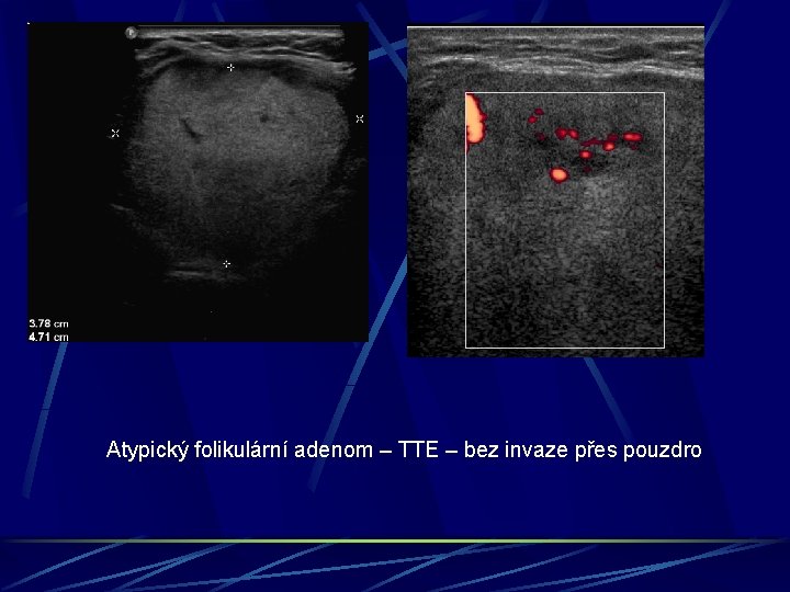 Atypický folikulární adenom – TTE – bez invaze přes pouzdro 