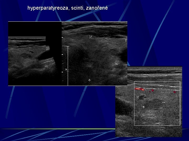 hyperparatyreoza, scinti, zanořené 