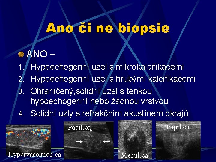 Ano či ne biopsie ANO – 1. Hypoechogenní uzel s mikrokalcifikacemi 2. Hypoechogenní uzel