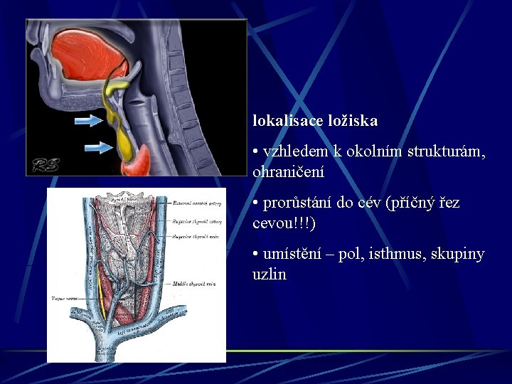 lokalisace ložiska • vzhledem k okolním strukturám, ohraničení • prorůstání do cév (příčný řez