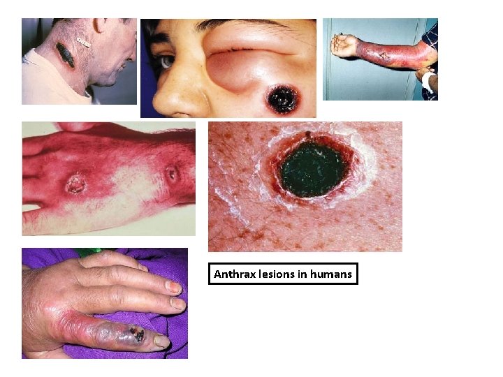 Anthrax lesions in humans 