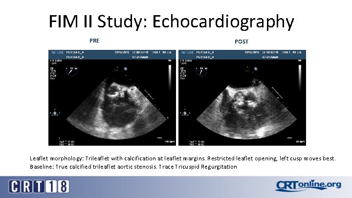 FIM II Study: Echocardiography PRE POST Leaflet morphology: Trileaflet with calcification at leaflet margins.