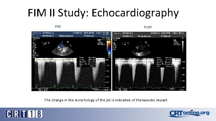 FIM II Study: Echocardiography PRE POST The change in the morphology of the jet