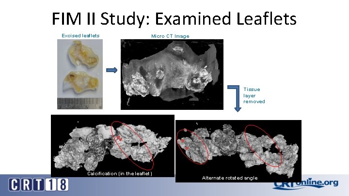FIM II Study: Examined Leaflets Excised leaflets Micro CT Image Tissue layer removed Calcification