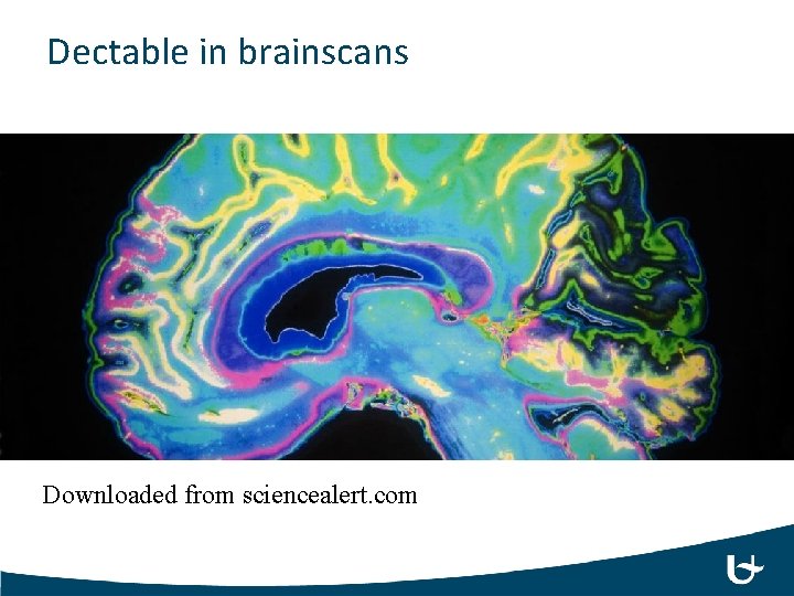 Dectable in brainscans Downloaded from sciencealert. com 
