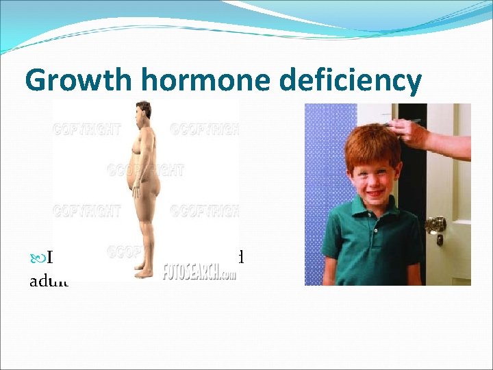 Growth hormone deficiency Diagnosis in children and adult 