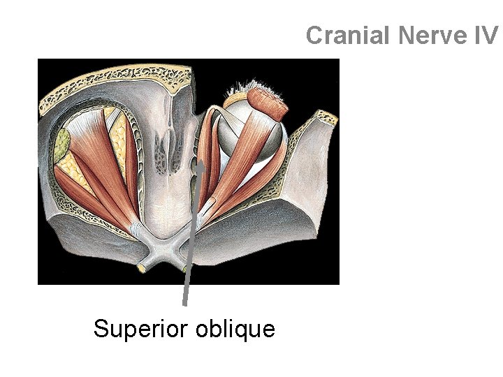 Cranial Nerve IV Superior oblique 