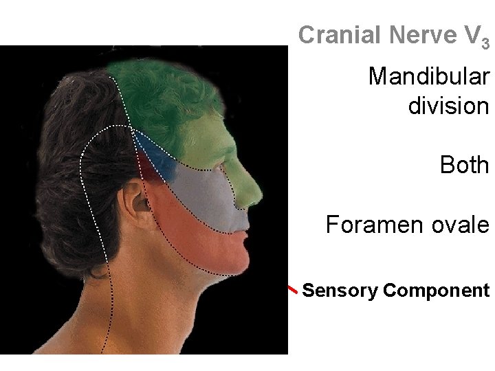 Cranial Nerve V 3 Mandibular division Both Foramen ovale Sensory Component 