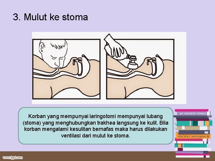 3. Mulut ke stoma Korban yang mempunyai laringotomi mempunyai lubang (stoma) yang menghubungkan trakhea