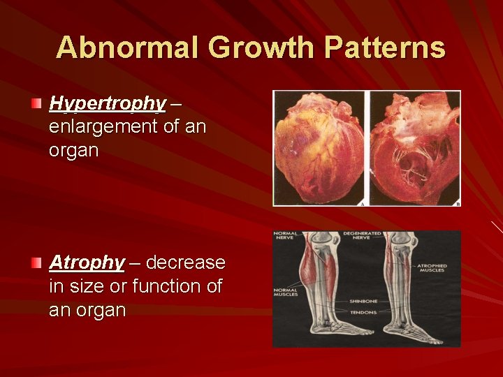 Abnormal Growth Patterns Hypertrophy – enlargement of an organ Atrophy – decrease in size