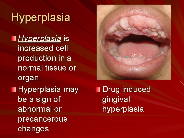 Hyperplasia is increased cell production in a normal tissue or organ. Hyperplasia may be