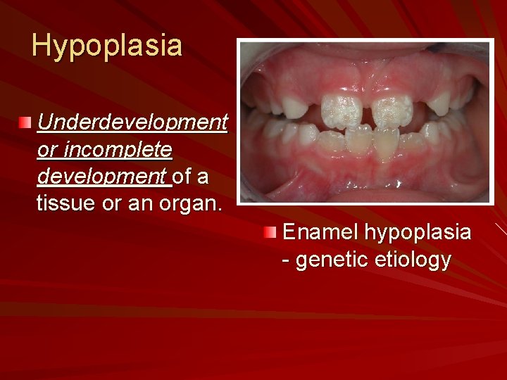 Hypoplasia Underdevelopment or incomplete development of a tissue or an organ. Enamel hypoplasia -