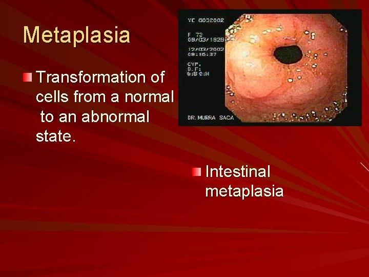 Metaplasia Transformation of cells from a normal to an abnormal state. Intestinal metaplasia 