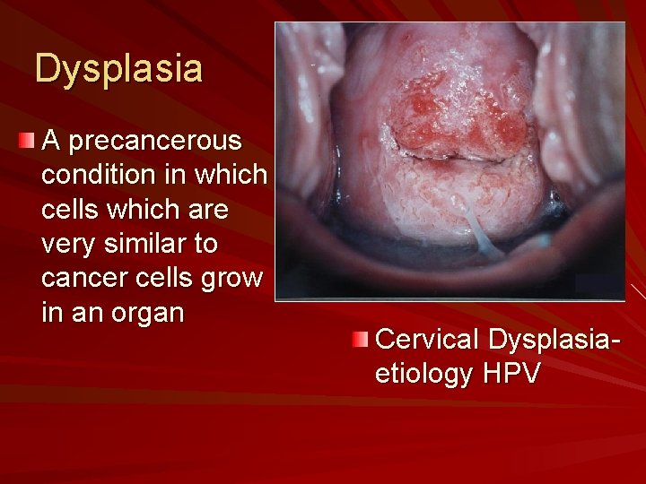 Dysplasia A precancerous condition in which cells which are very similar to cancer cells