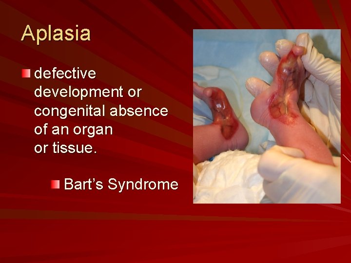 Aplasia defective development or congenital absence of an organ or tissue. Bart’s Syndrome 