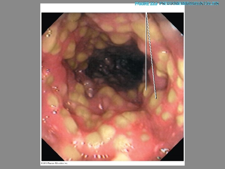FIGURE 23. 9 PSEUDOMEMBRANOUS COLITIS Lesions 