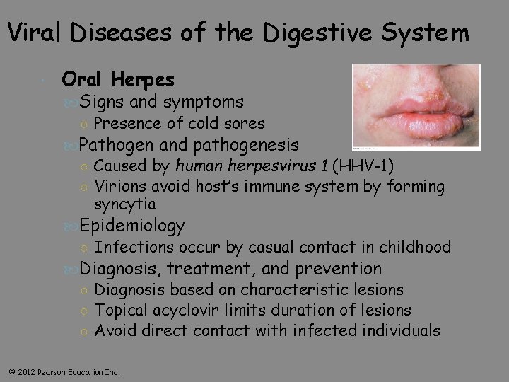 Viral Diseases of the Digestive System Oral Herpes Signs and symptoms ○ Presence of