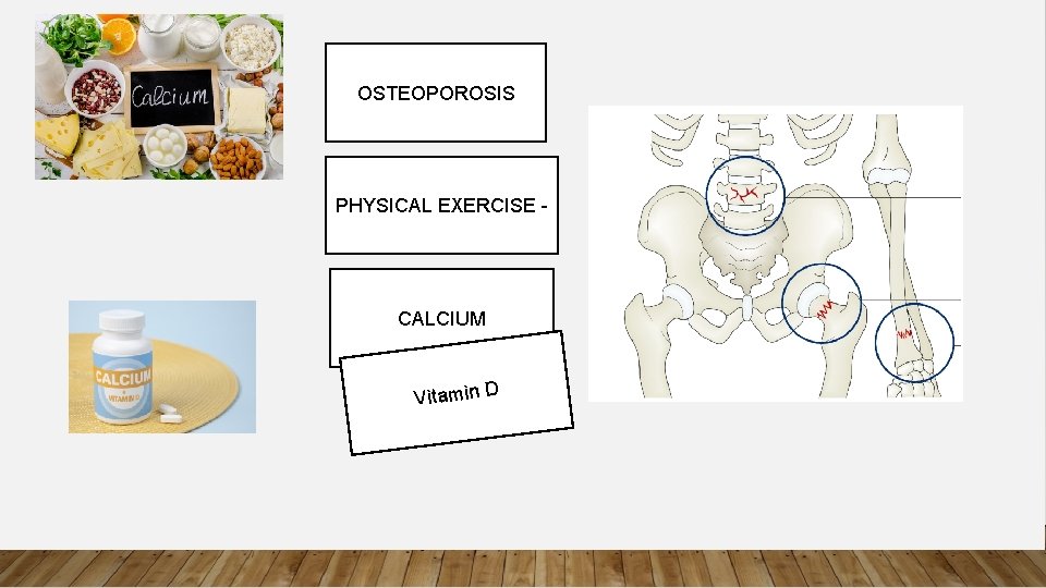 OSTEOPOROSIS PHYSICAL EXERCISE - CALCIUM Vitamin D 