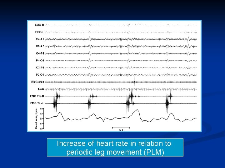 Increase of heart rate in relation to periodic leg movement (PLM) 