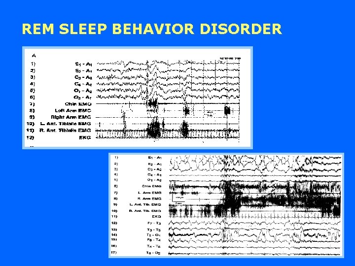 REM SLEEP BEHAVIOR DISORDER 