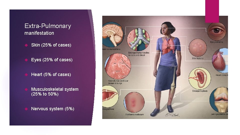 Extra-Pulmonary manifestation Skin (25% of cases) Eyes (25% of cases) Heart (5% of cases)