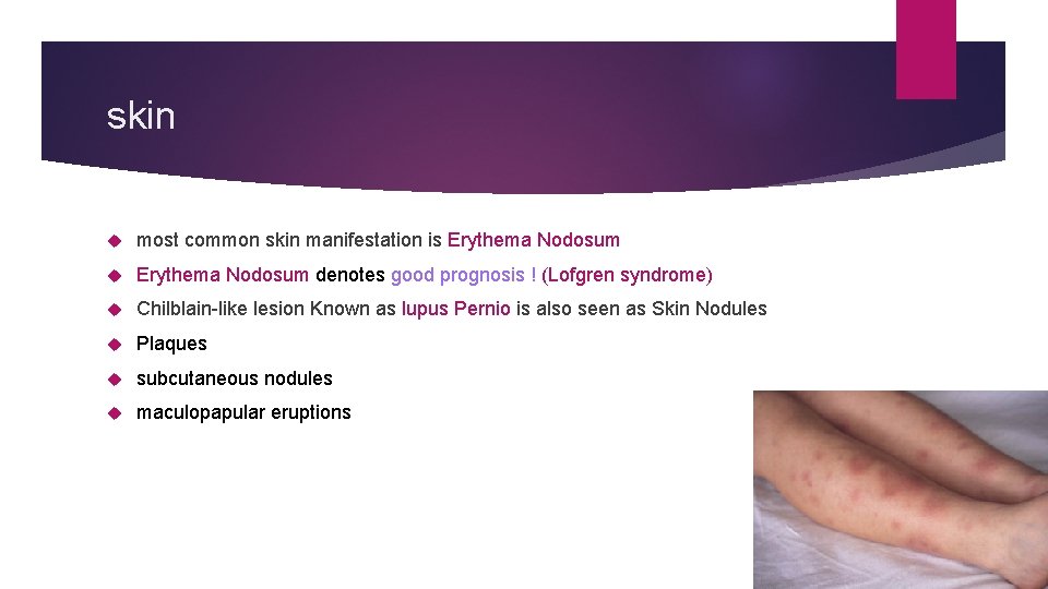 skin most common skin manifestation is Erythema Nodosum denotes good prognosis ! (Lofgren syndrome)