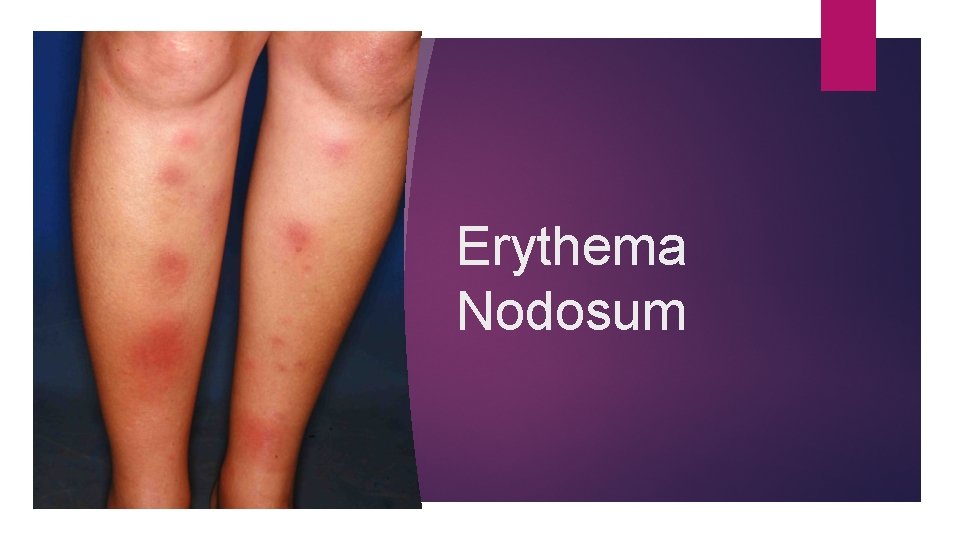 Erythema Nodosum 