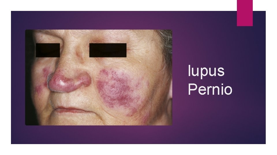 lupus Pernio 