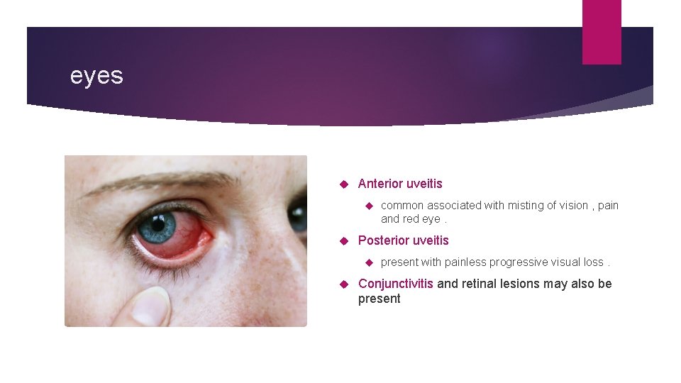 eyes Anterior uveitis Posterior uveitis common associated with misting of vision , pain and