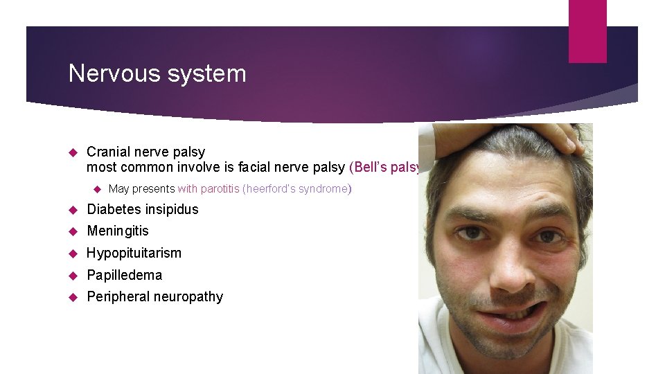 Nervous system Cranial nerve palsy most common involve is facial nerve palsy (Bell’s palsy)