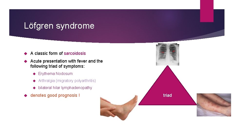 Löfgren syndrome A classic form of sarcoidosis Acute presentation with fever and the following