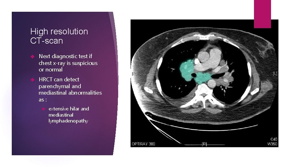 High resolution CT-scan Next diagnostic test if chest x-ray is suspicious or normal HRCT