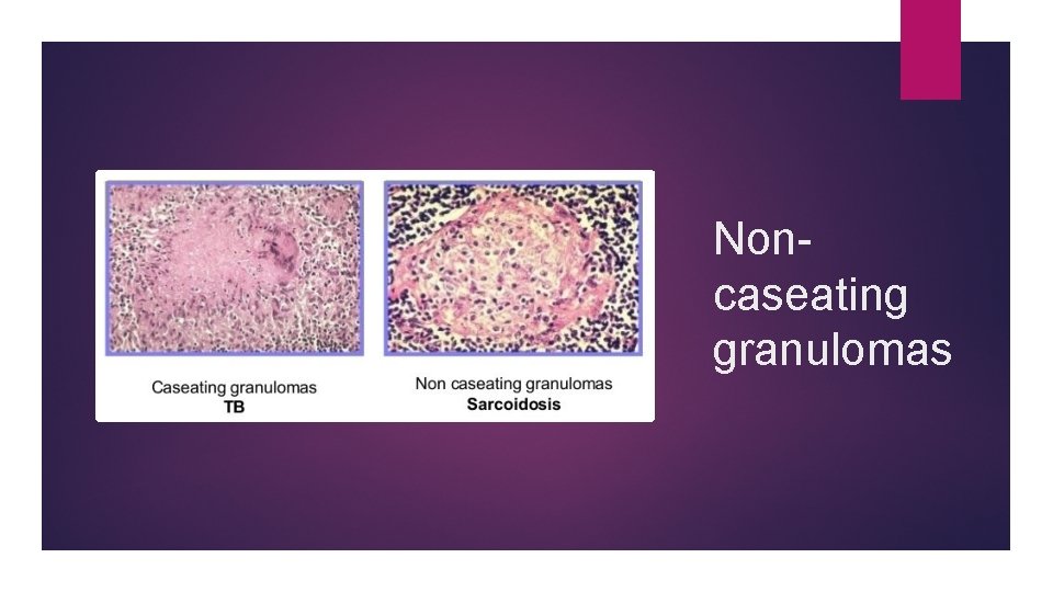 Noncaseating granulomas 