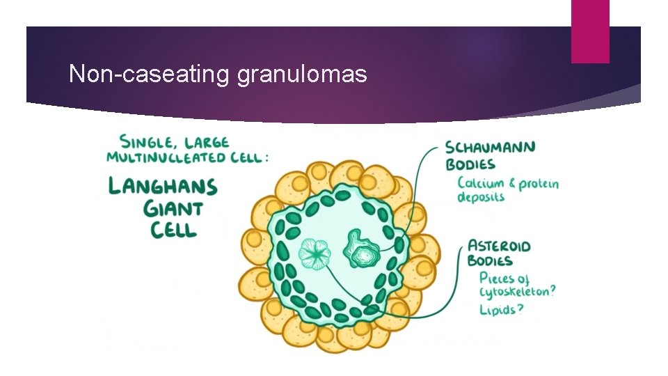Non-caseating granulomas 