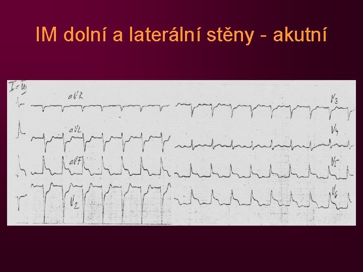 IM dolní a laterální stěny - akutní 