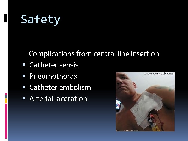 Safety Complications from central line insertion Catheter sepsis Pneumothorax Catheter embolism Arterial laceration 