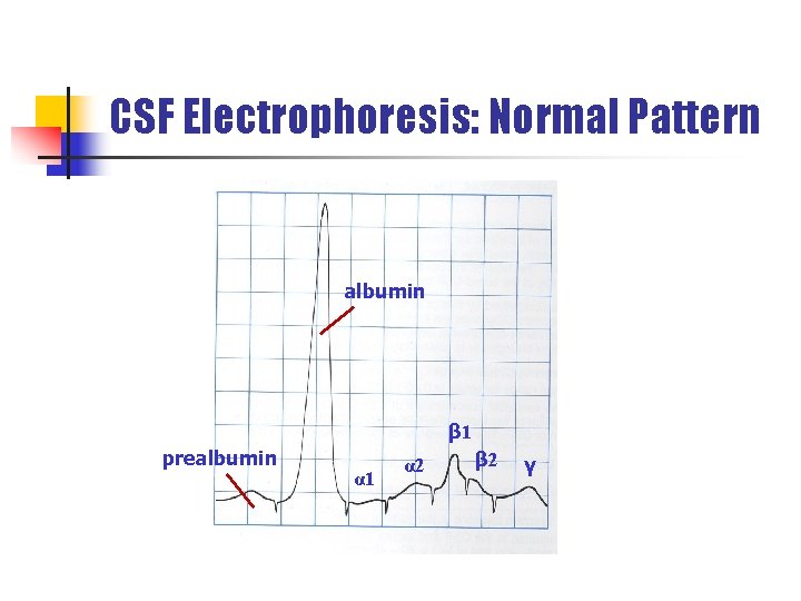 CSF Electrophoresis: Normal Pattern albumin β 1 prealbumin α 1 α 2 β 2