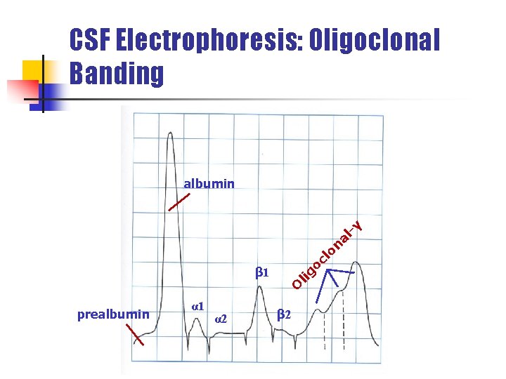 CSF Electrophoresis: Oligoclonal Banding β 1 prealbumin α 1 α 2 O lig oc