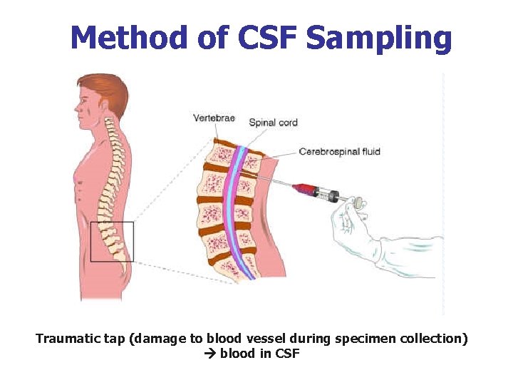 Method of CSF Sampling Traumatic tap (damage to blood vessel during specimen collection) blood